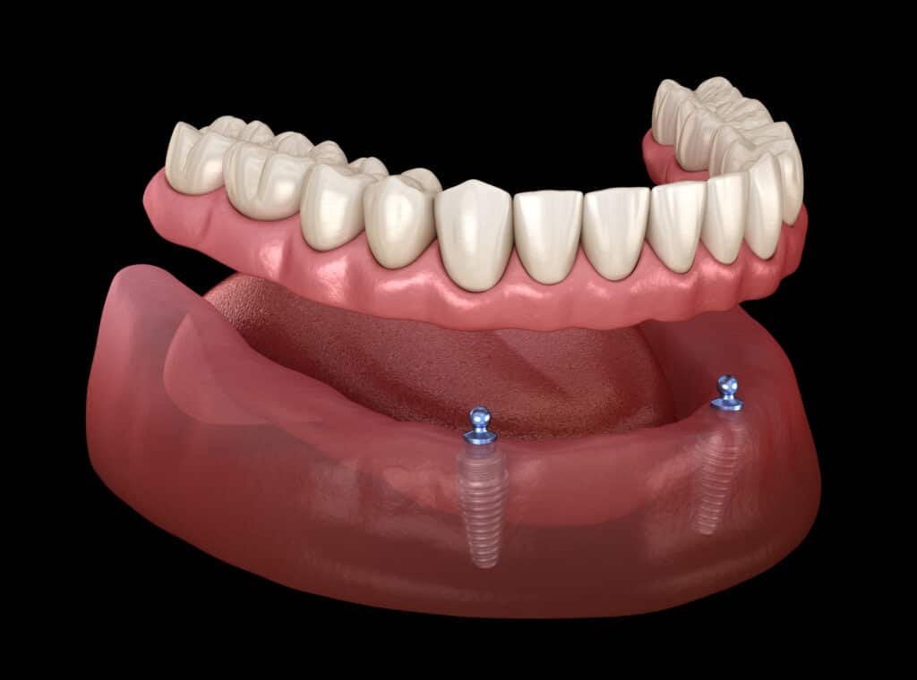 Snap-Retained Overdentures