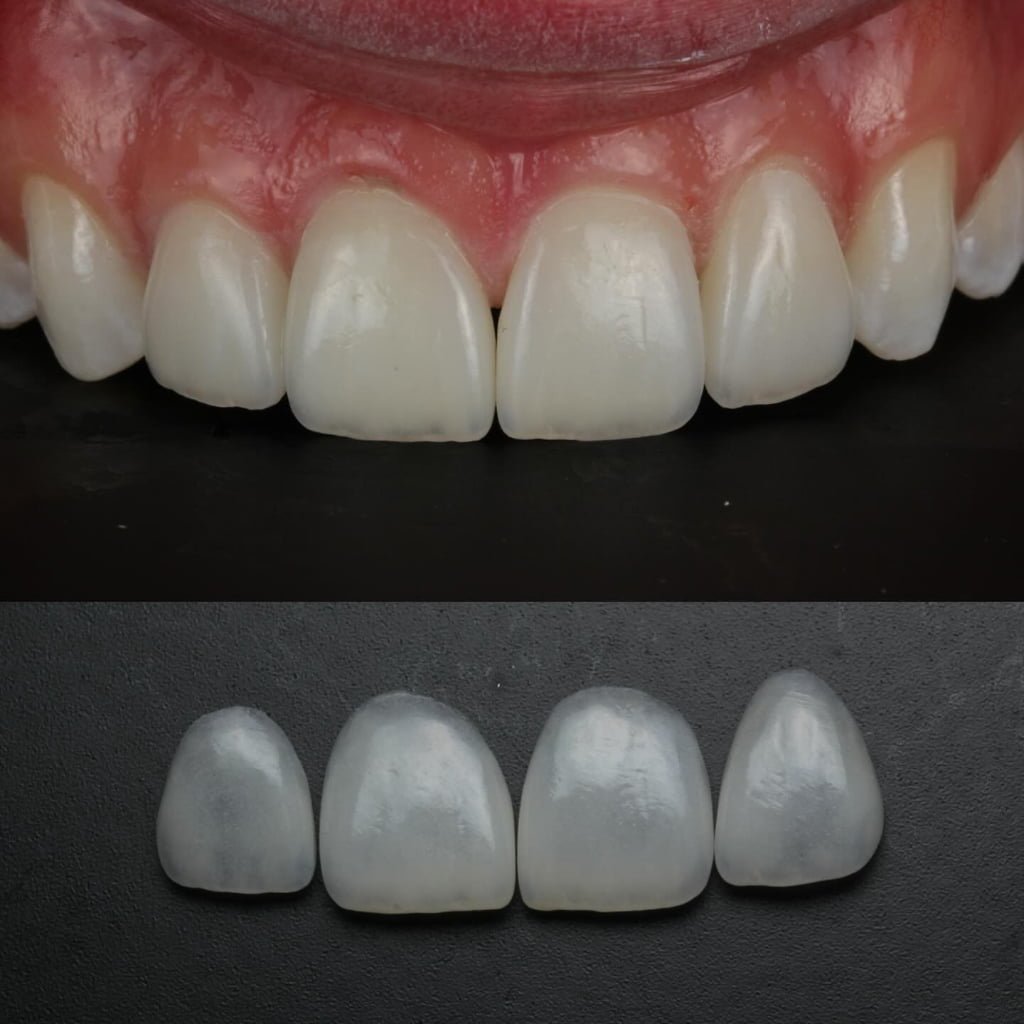 Feldspathic Veneers