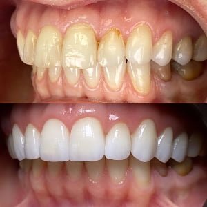 IPS Empress Veneers - 