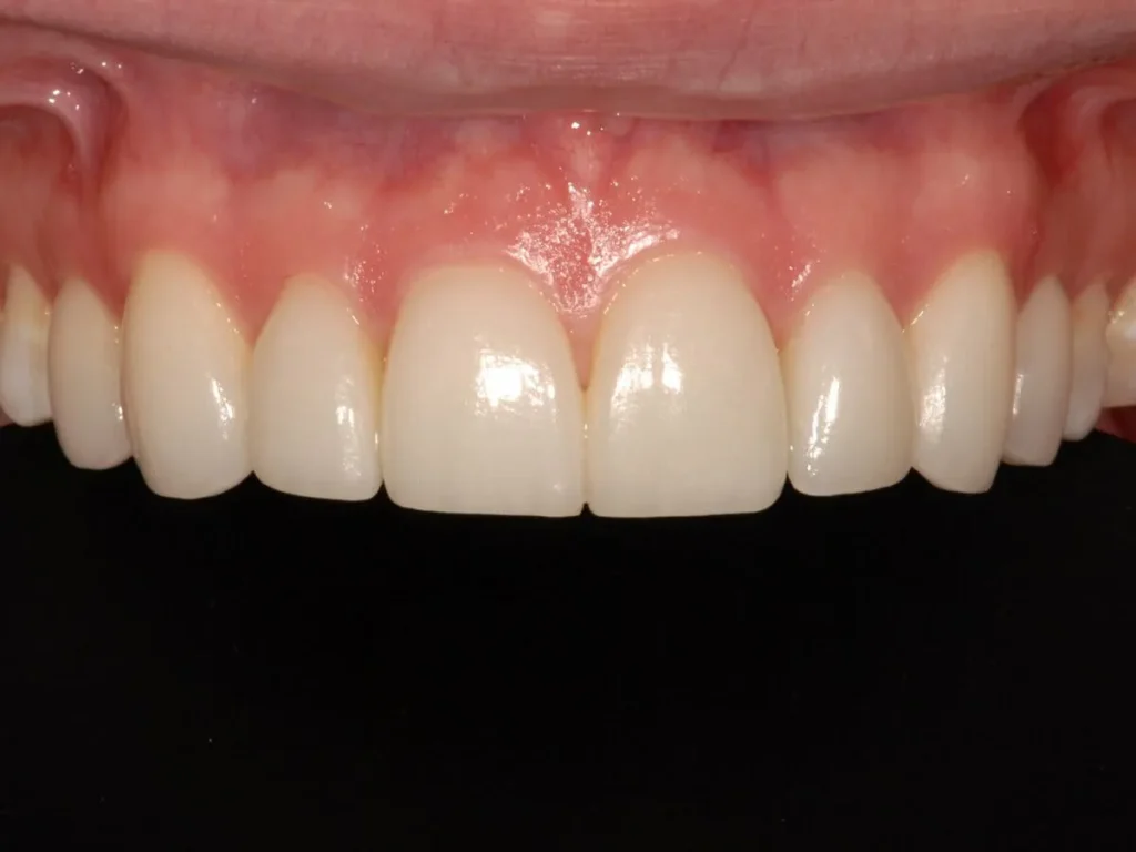 Laminate Veneers