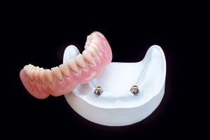 Locator-Retained Overdentures - 