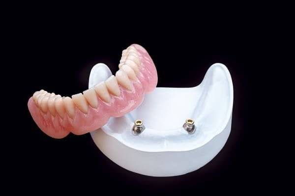 Locator-Retained Overdentures