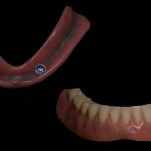 Locator Fixed Dentures