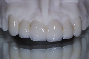 PMMA Temporary Crown - 