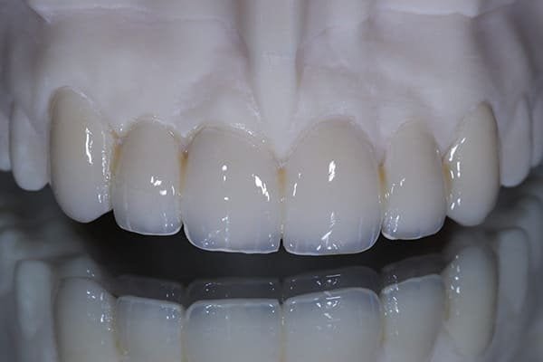 PMMA Temporary Crown