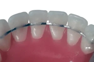 Lingual Wire Retainer - 
