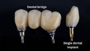 Screw-Retained Implant Crown & Bridge - 