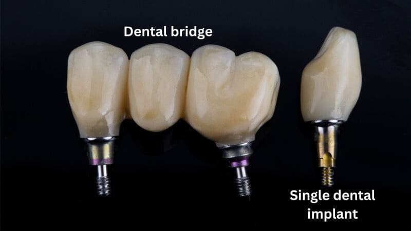 Screw-Retained Implant Crown & Bridge