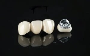 Semi-precious PFM Crowns - 