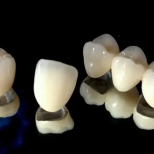 Semi-precious PFM Crowns