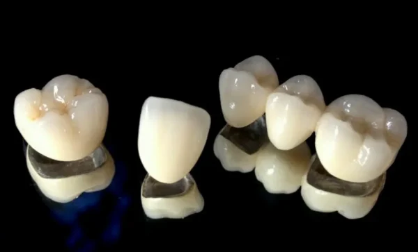 Semi-precious PFM Crowns