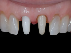 Zirconia Post & Core - 