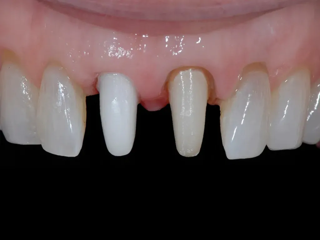 Zirconia Post & Core