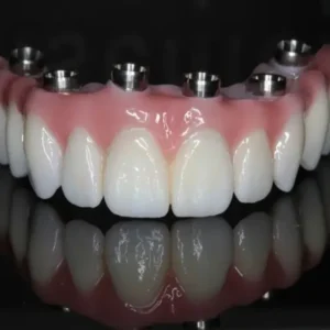 All-Zirconia Screw-Retained Bridge