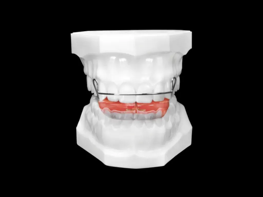 Bionator Appliance