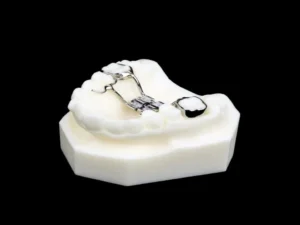 Bonded palatal expander - 