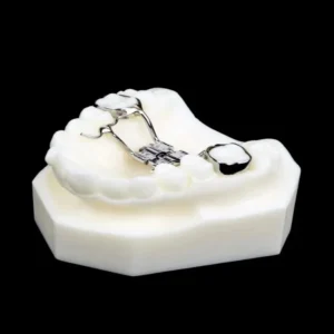 Bonded Palatal Expande