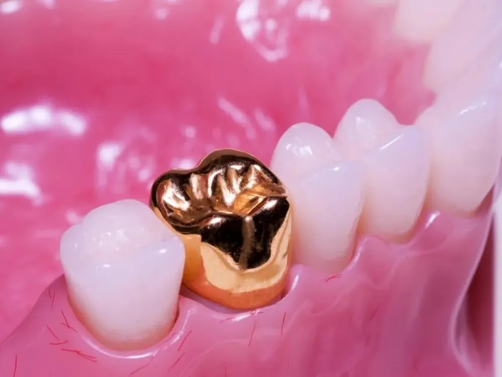 Full Cast Crown & Bridge