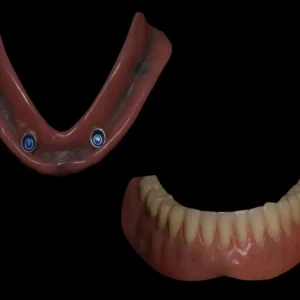 Locator Fixed Dentures