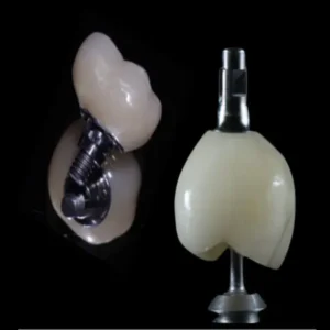 Screw-Retained Implants