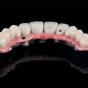 Snap-In Dentures