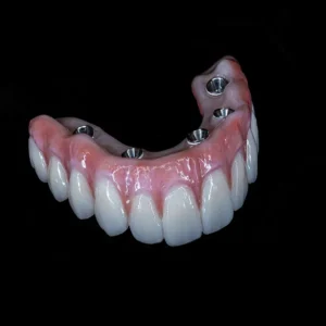 Titanium Hybrid Dentures