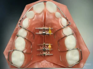 Removable palatal expander - 