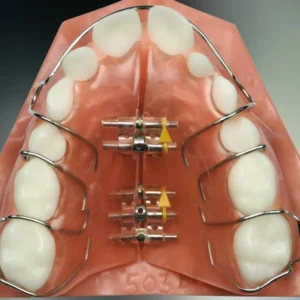 removable palatal expander