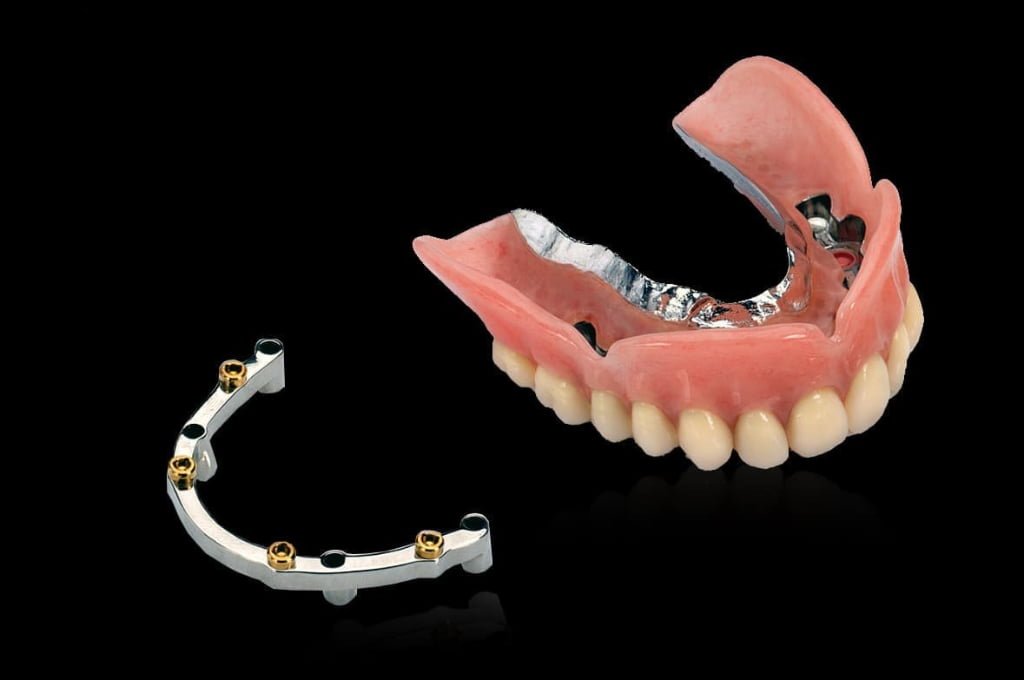 Bar-Retained Overdentures