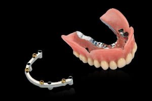Bar-Retained Overdentures - 