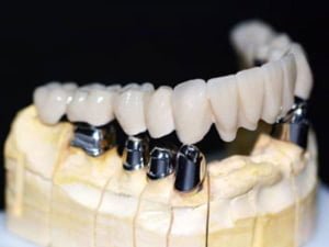 Cement-Retained Implant Crown & Bridge - 