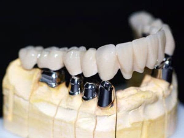 Cement-Retained Implant Crown & Bridge