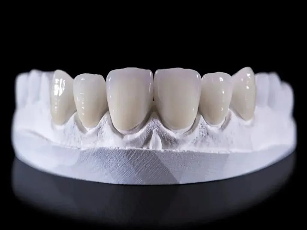 Zirconia Crown and Bridge Restoration
