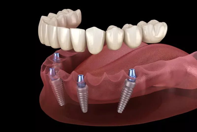 Dental Implants
