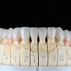 Layered Zirconia Crown & Bridge - 