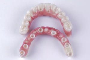 Zirconia Full-Arch Bridges - 