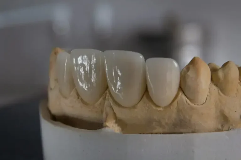 Less than 30 µm Marginal Fit Zero-Adjustment Restorations