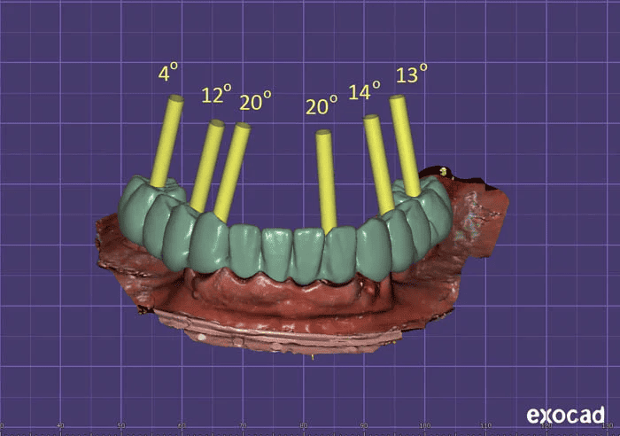 All On X Design Raytops Dental Lab (2)