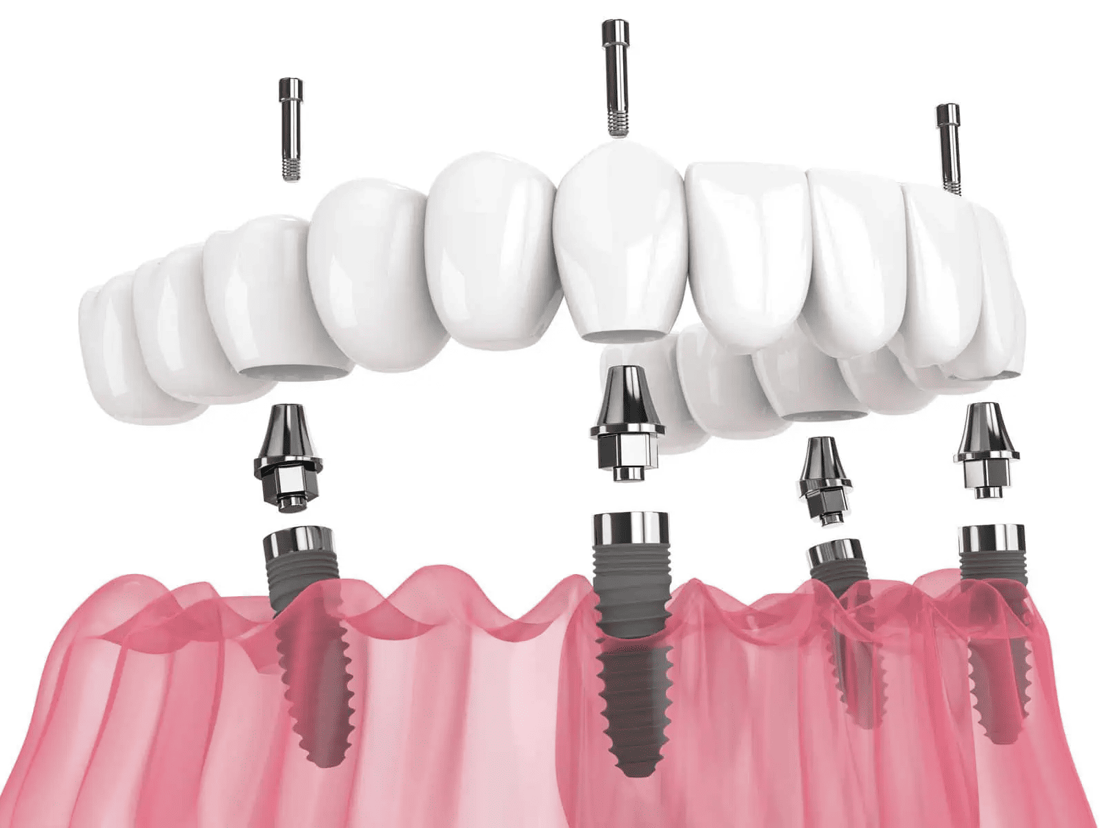 All On X Design Raytops Dental Lab (4)