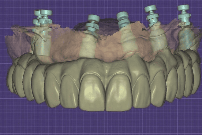 All On X Design Raytops Dental Lab (6)