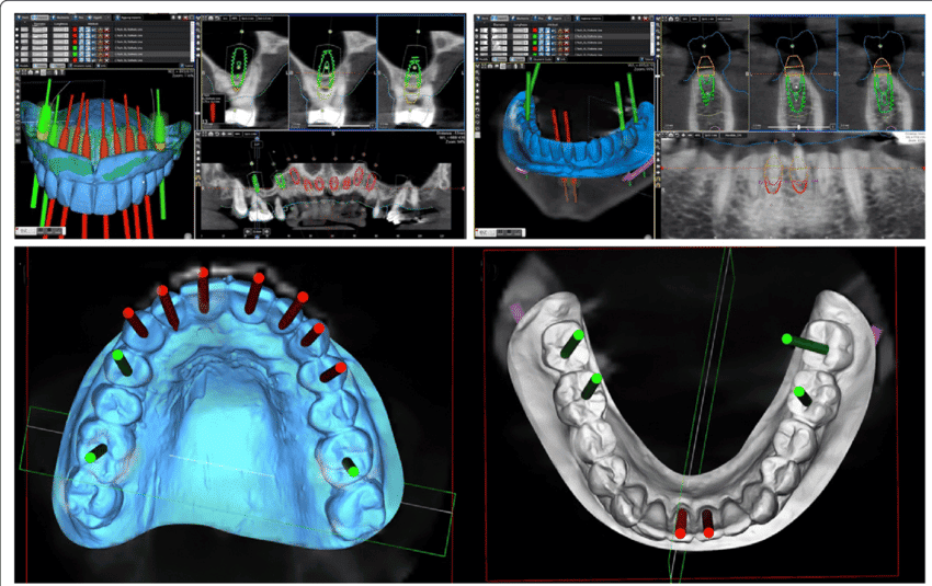 Raytops Surgical Guide Planning + Design 3