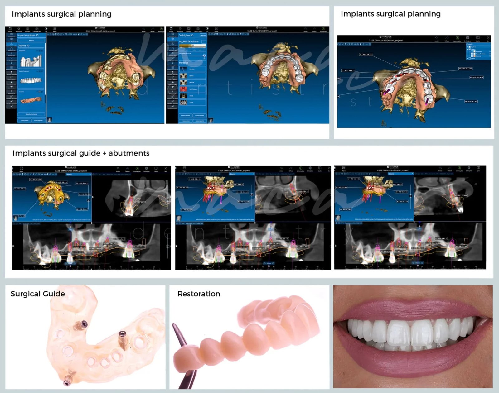 Raytops Surgical Guide Planning + Design 5
