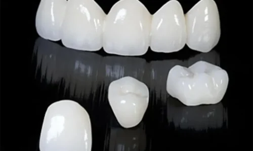 All Ceramic Crown & Bridge